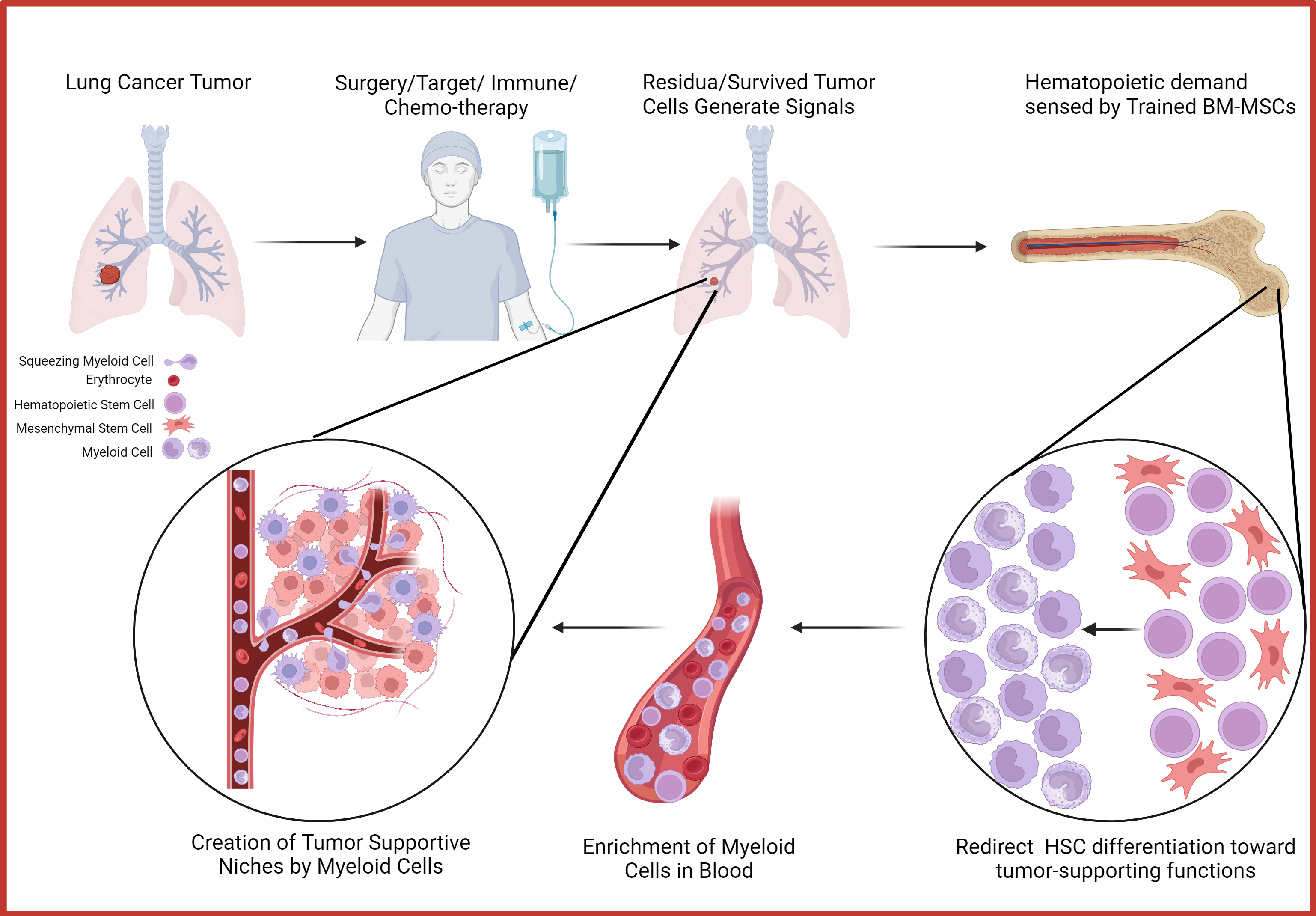 Bone Marrow Mesenchymal Cell as sensor of early relapse in lung cancer